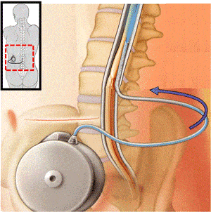 Neuro Stimulator-Medical Electronics applications